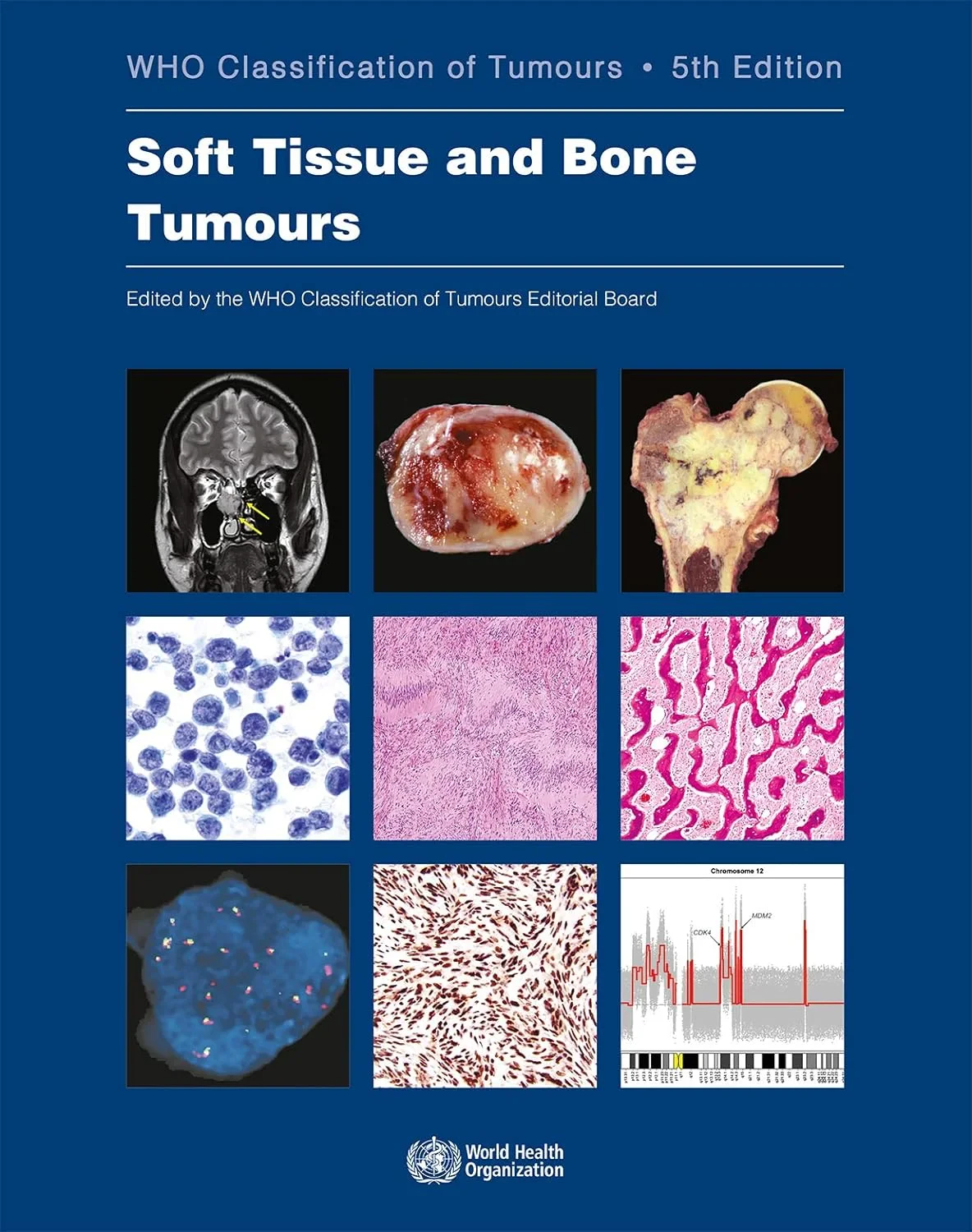 Soft Tissue and Bone Tumours. WHO Classification o...