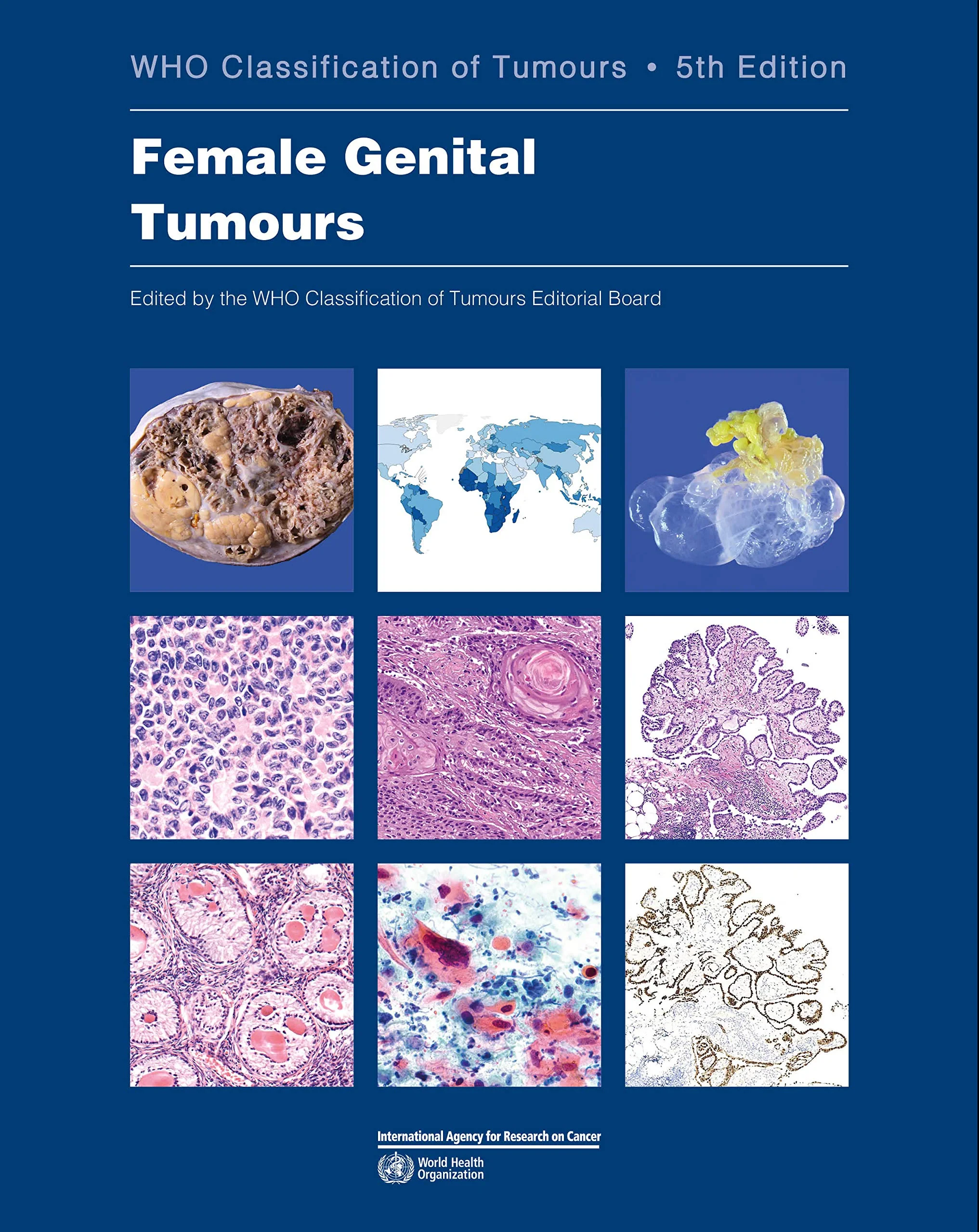 WHO classification of female genital tumours: Who ...