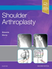 Shoulder Arthroplasty, 2e 