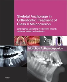 Skeletal Anchorage in Orthodontic Treatment of Cla...