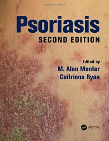 Psoriasis, Second Edition 
