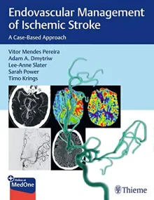 Endovascular Management of Ischemic Stroke: A Case...