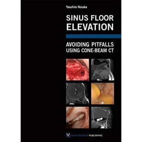 Sinus Floor Elevation: Avoiding Pitfalls Using Con...