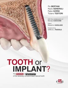 Tooth or Implant?: The recovery or replacement of ...