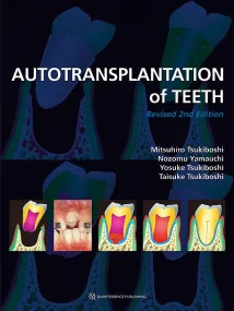 Autotransplantation of Teeth