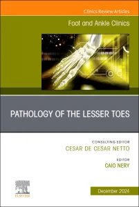 Pathology of the Lesser Toes, An issue of Foot and...